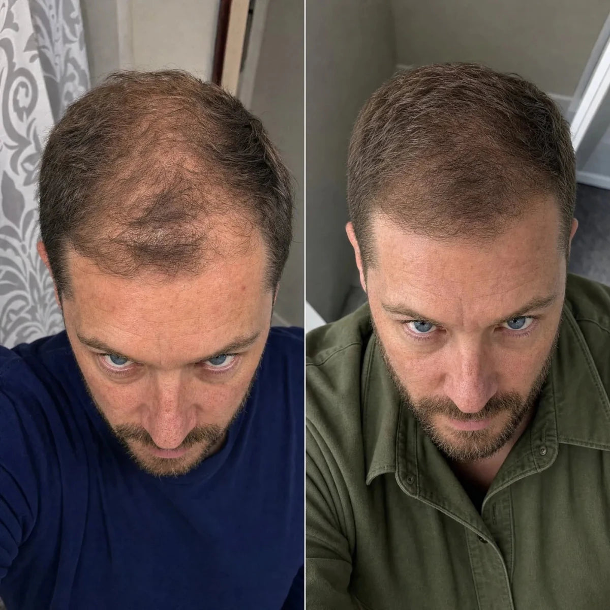 NovaMane Lumen Tri-Wave Hair Growth Laser Cap - NovaMane