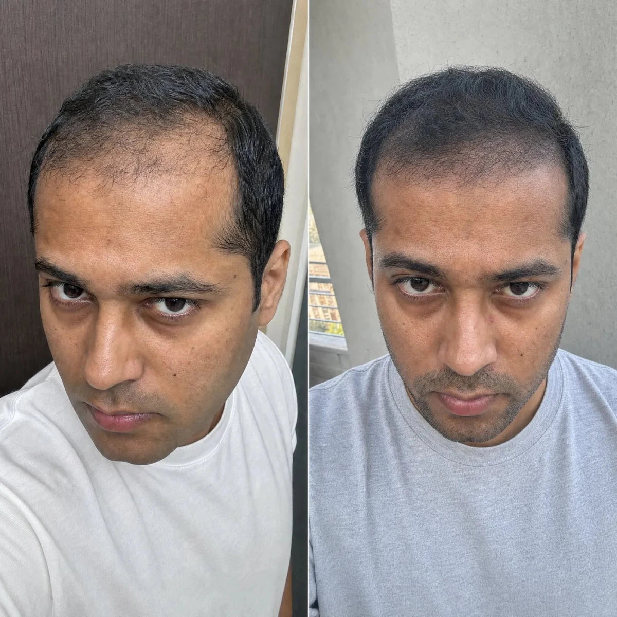 NovaMane Lumen Tri-Wave Hair Growth Laser Cap - NovaMane