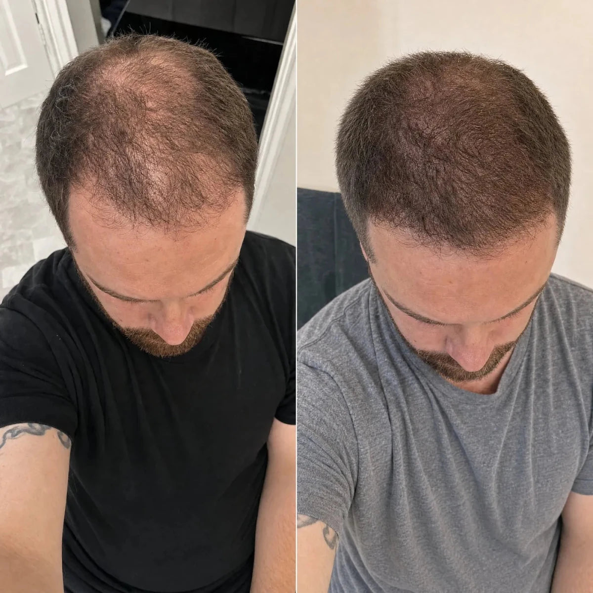 NovaMane Lumen Tri-Wave Hair Growth Laser Cap - NovaMane