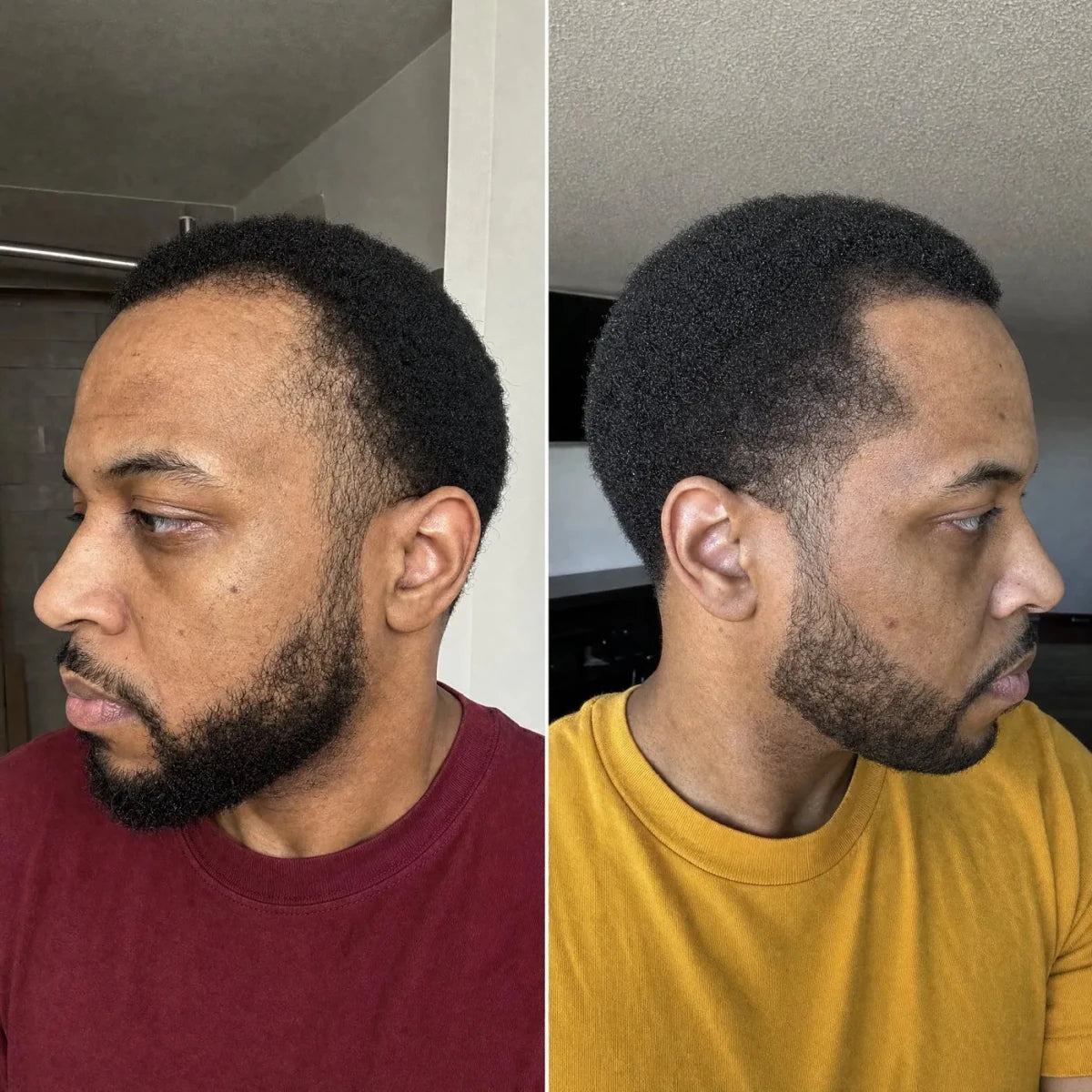 NovaMane Lumen Tri-Wave Hair Growth Laser Cap - NovaMane