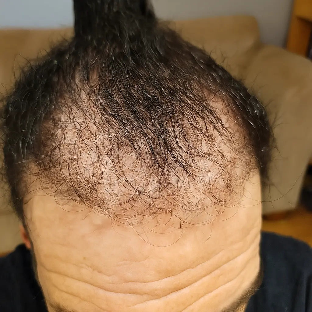 poor_growth_unnatural_hairline